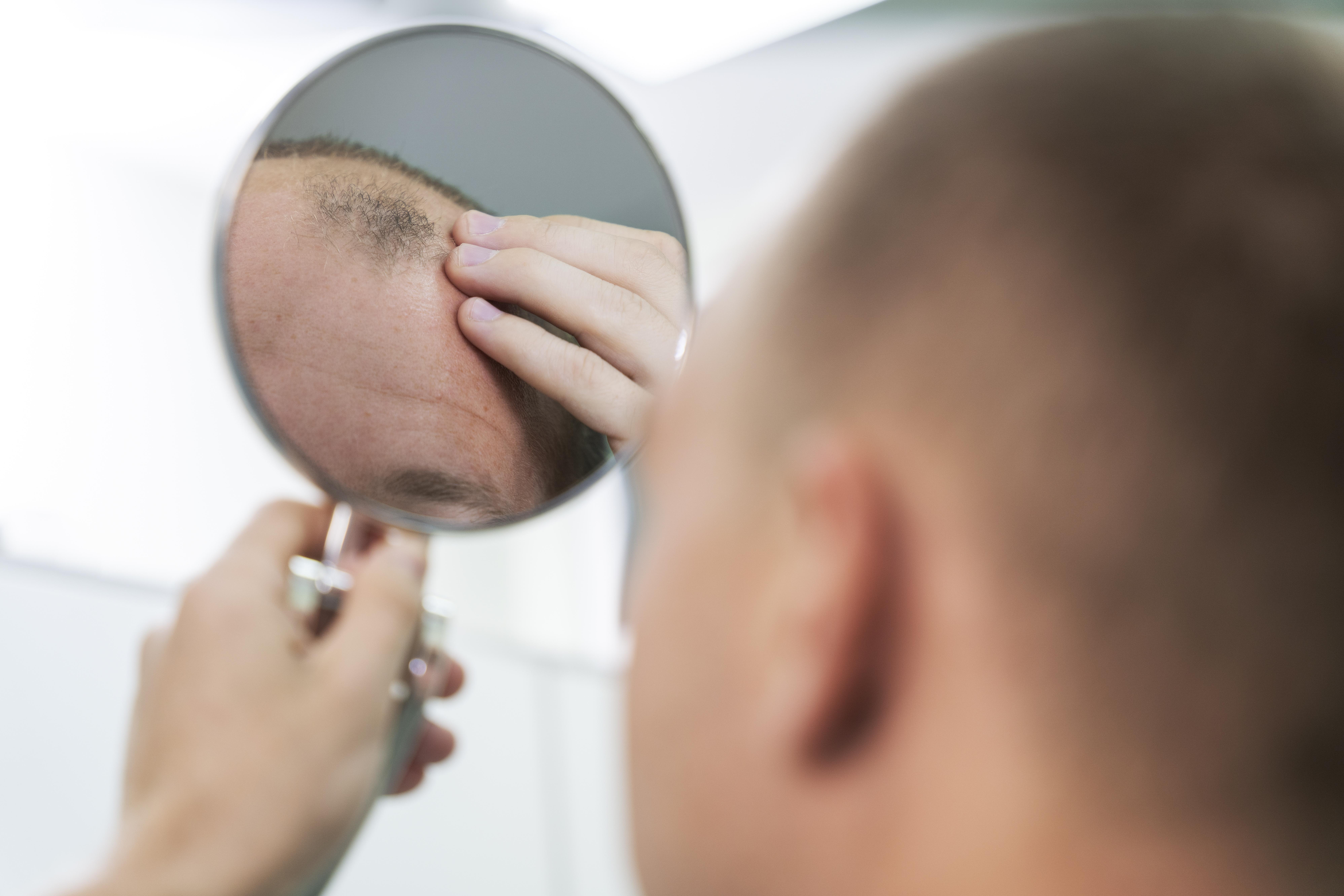 Calvicie, caída de cabello, perida de cabello, tricología, crecer cabello, pelo.